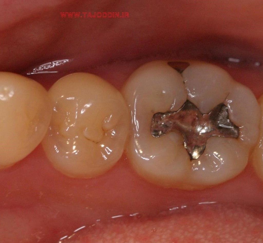 آشنایی و مضررات آمالگام ماده پرکردن دندان Dental amalgam composition