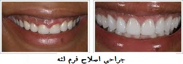 سریعترین راه رسیدن به لبخند زیبا چیست؟